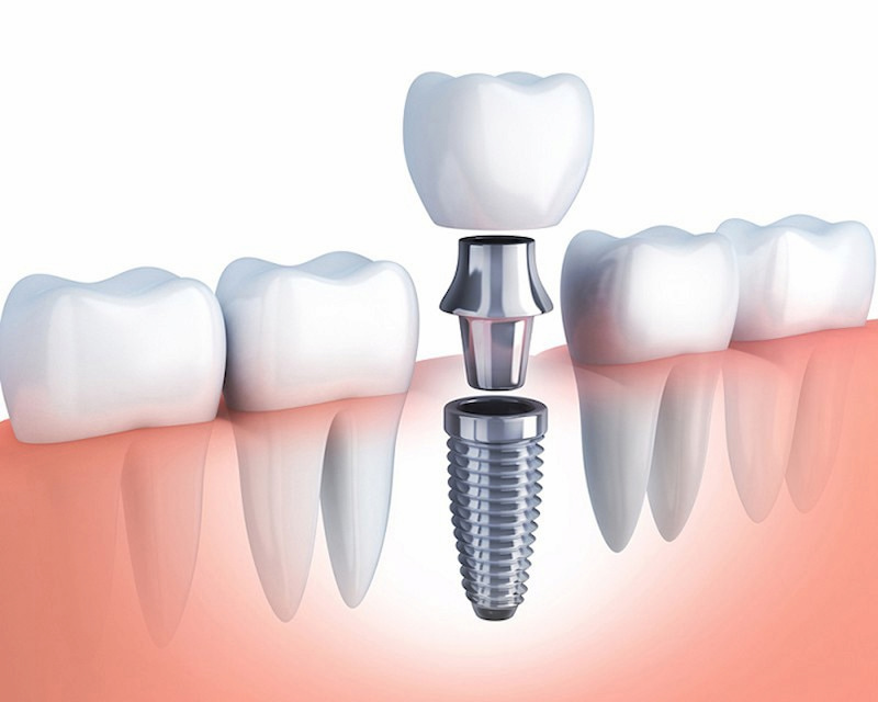 Công nghệ trồng răng Implant được nhiều người chọn lựa