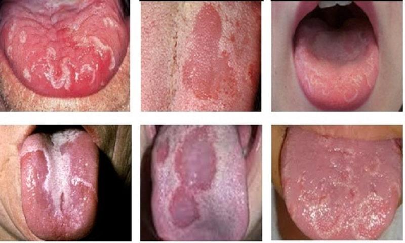 Tình trạng viêm lưỡi bản đồ