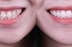 Tự tin với nụ cười của chính mình nhờ kỹ thuật dán răng sứ