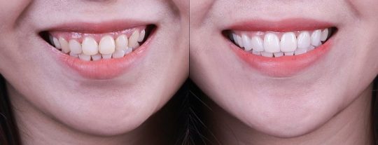 Tự tin với nụ cười của chính mình nhờ kỹ thuật dán răng sứ