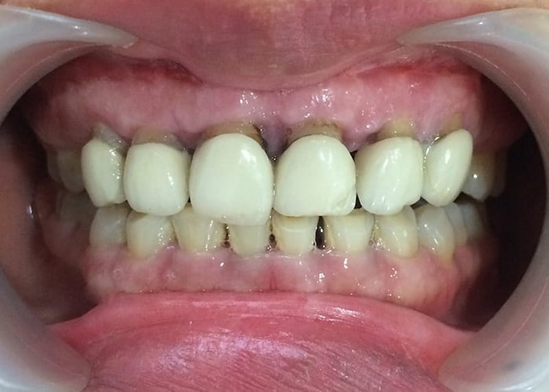 Nhiều trường hợp hỏng răng vì dán sứ, bọc sứ thẩm mỹ